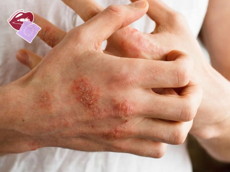 Dị ứng hoặc kích ứng với chất liệu