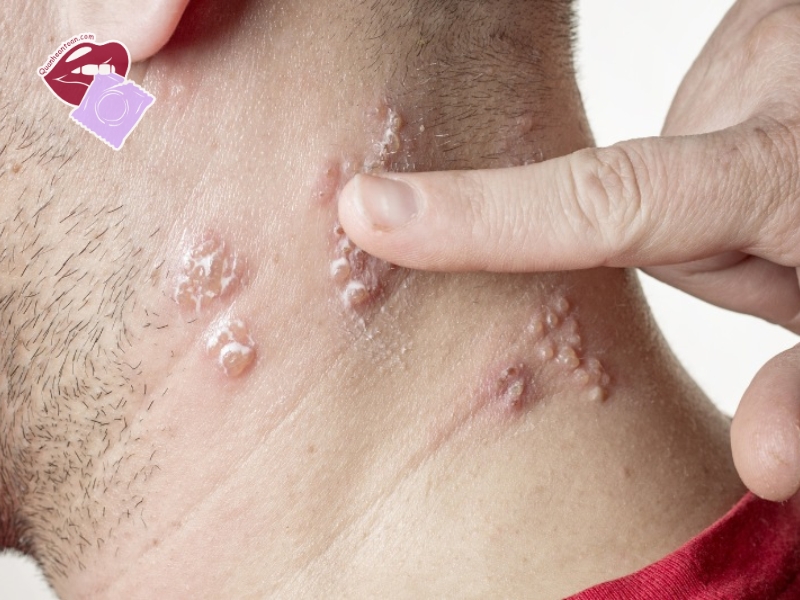 Các bệnh lây truyền qua quan hệ bằng miệng